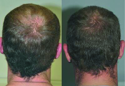SCOPERTE MOLECOLE PER far ricrescere i capelli