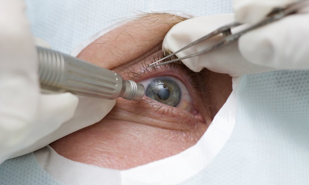 Nuova tecnica laser per trapianto cornea
