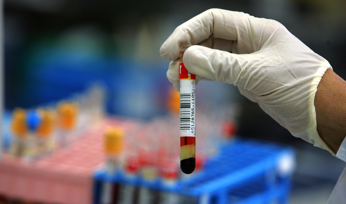 UN ESAME DEL SANGUE  PER SCOPRIRE L’ALZHEIMER