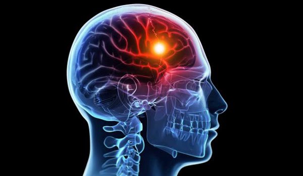 ICTUS: INSORGENZA A ETÀ  PIÙ AVANZATA E IN FORME PIÙ LIEVI